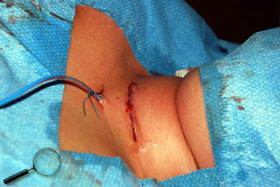 Chirurgie de la thyroide, incision cutanee
